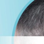 Haut-Trattner-Behandlung-Erkrankung-Haarausfall