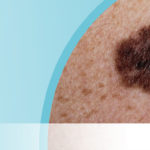 Haut-Trattner-Hautkrebs-Behandlung-Erkrankung-Schwarzer-Hautkrebs