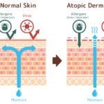 Haut Trattner - Neurodermitis Entstehung