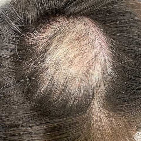 Haarausfall - Hautarzt Dr. Hannes Trattner