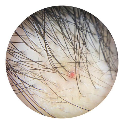 Androgenetische Alopezie (erblich bedingter Haarausfall)
