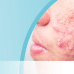Hautarzt Trattner-Behandlung-Erkrankung-Akne-